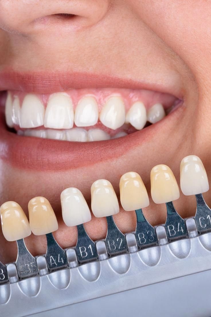 Imagen ilustrativa de una evaluación del tono dental con una guía de colores